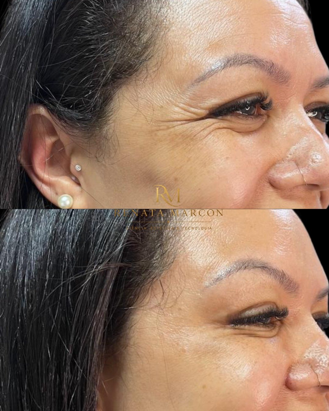 Antes e depois de Botox