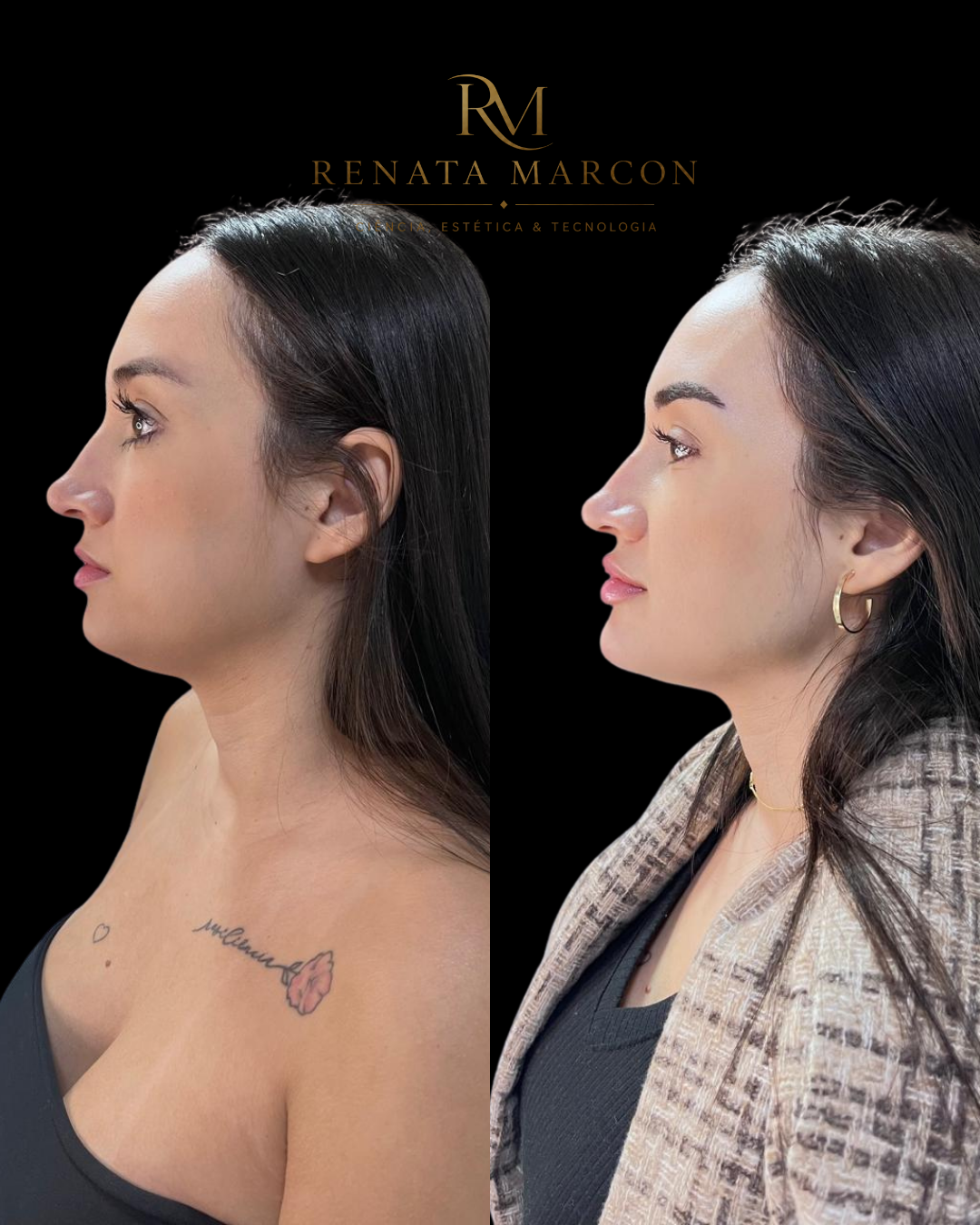 Antes e depois de Harmonização Facial