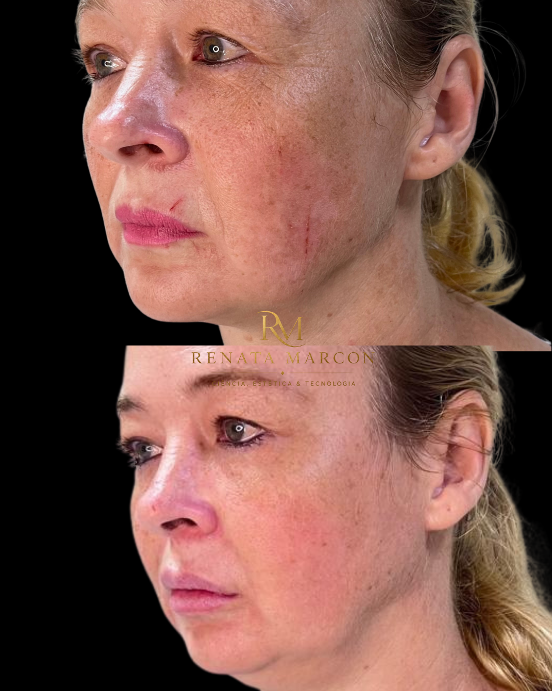 Antes e depois de Melasma