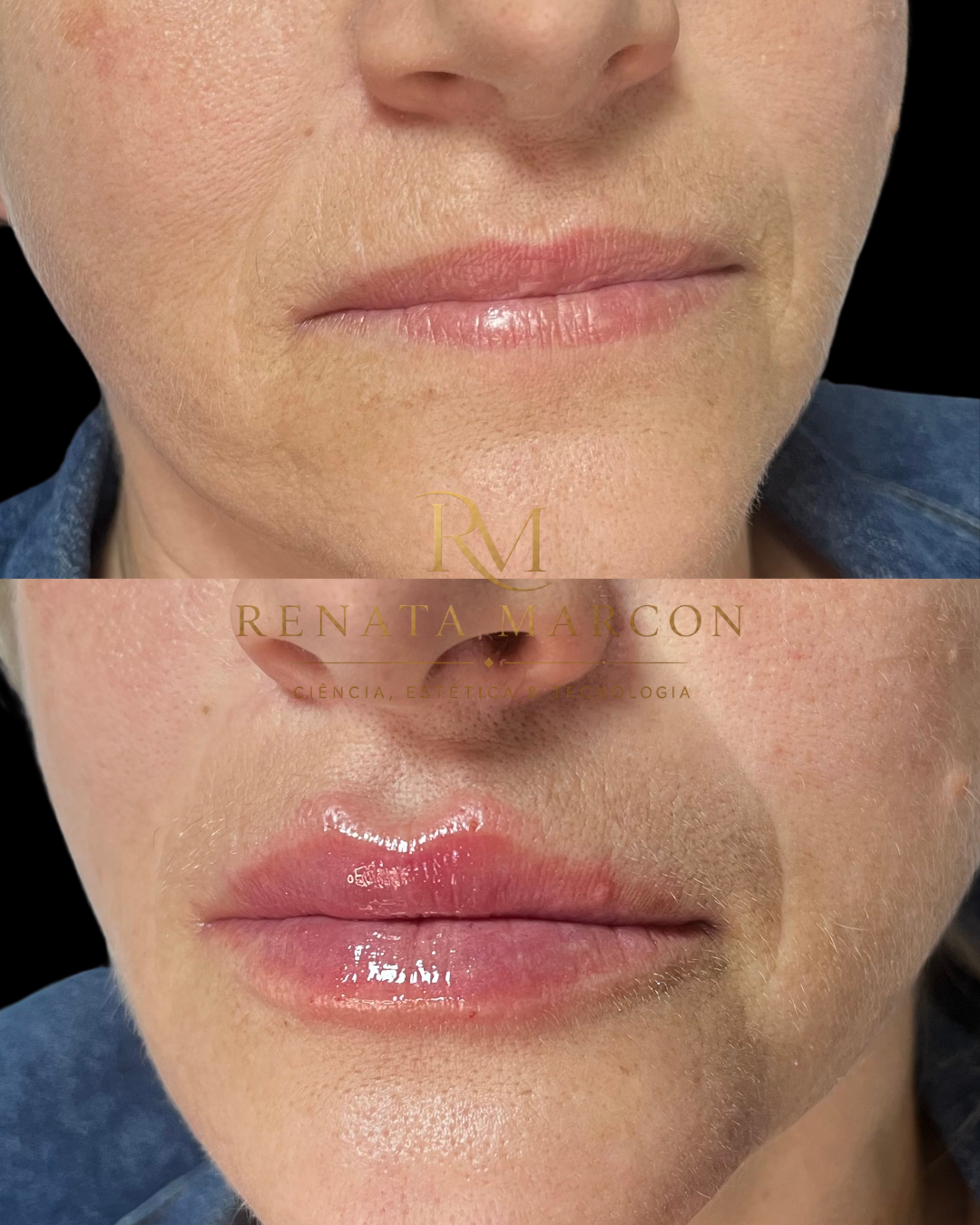 Antes e depois de Preenchimento Labial